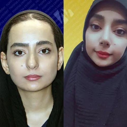 قبل و بعد از عمل بینی ترمیمی