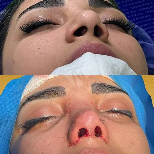 قبل و بعد از جراحی بینی در کلینیک نورسا