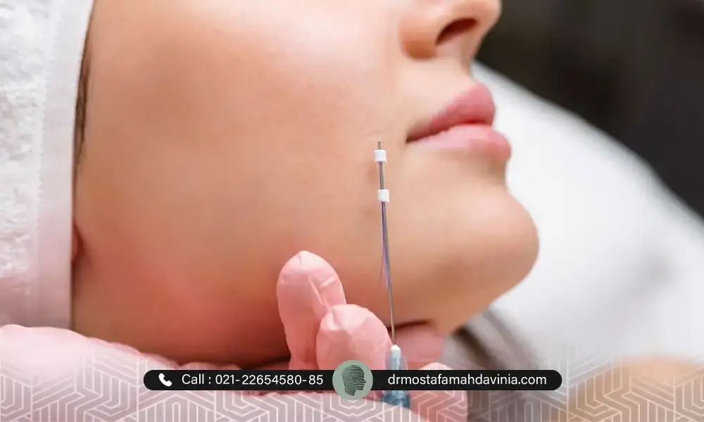 نواحی لیفت نخ