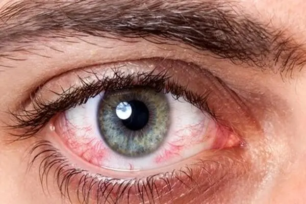 ۳۶۵ جراحی رایگان آب مروارید چشم در دزفول صورت گرفت
