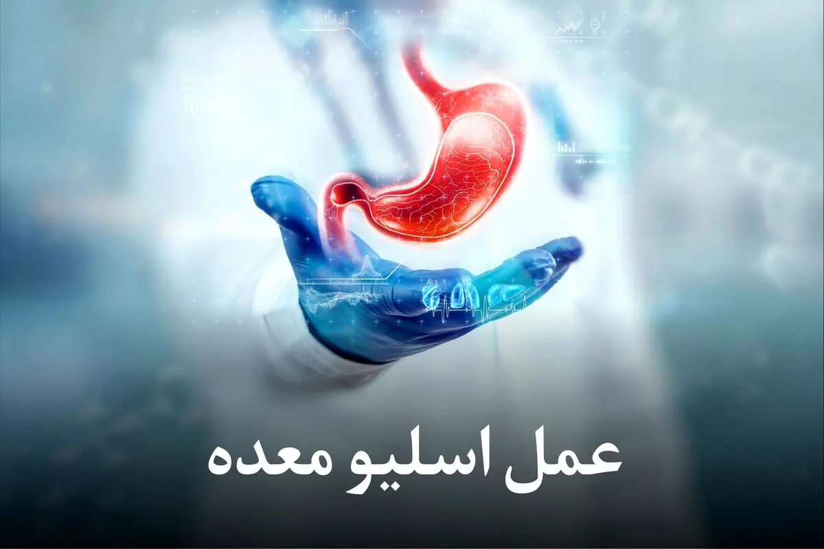 هزینه عمل اسلیو معده با بیمه تکمیلی | شرایط و میزان پوشش بیمه های مختلف