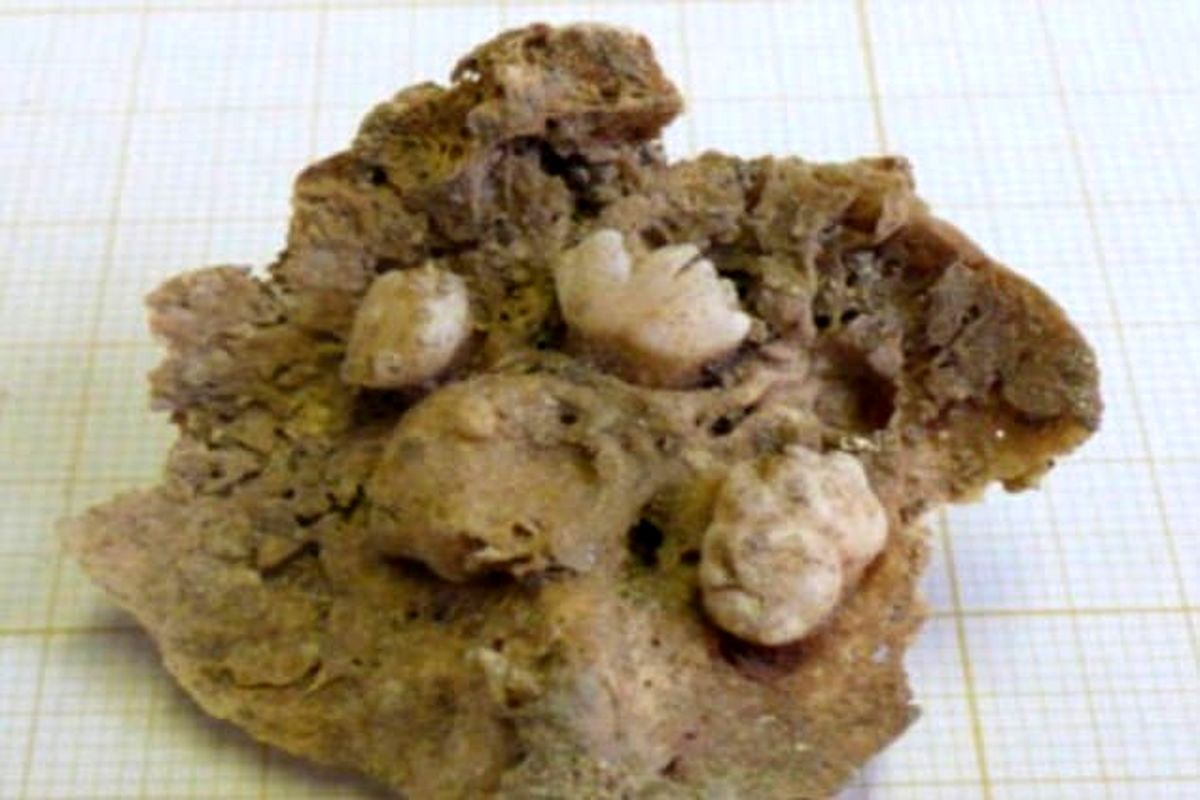 کشف تومور تخمدان 500 ساله توسط باستان‌شناسان