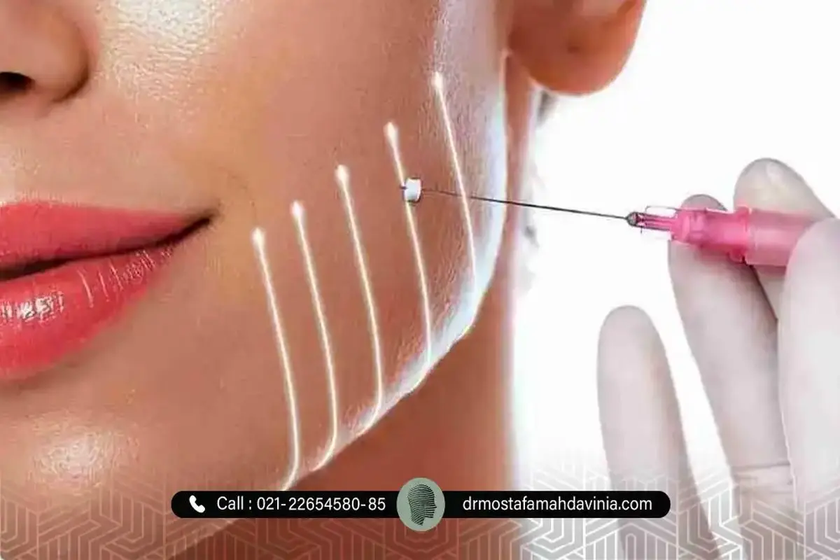 معرفی بهترین ناحیه ها برای لیفت با نخ