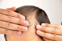 راهی جدید برای درمان ریزش مو