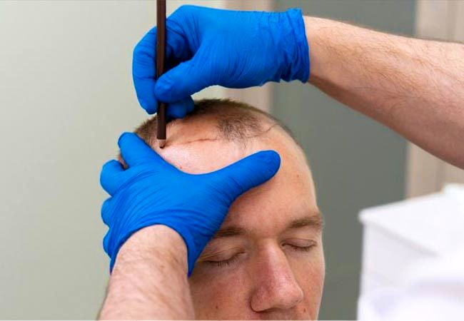 کاشت مو مصنوعی چیست و چه تفاوتی با کاشت مو طبیعی دارد؟