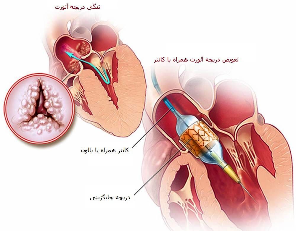 نخستین عمل کاشت دریچه آئورت به روش تاوی در مازندران