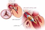 نخستین عمل کاشت دریچه آئورت به روش تاوی در مازندران