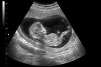 سونوگرافی برای جنین ضرر دارد؟