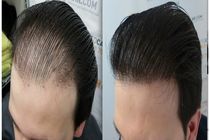 راه های جلوگیری و درمان چربی مو/چربی مو مهمترین عامل ریزش مو است