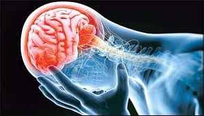 300 درمان موفق سکته مغزی حاد طی ۶ ماه گذشته/ علائم و نشانه‌های سکته مغزی