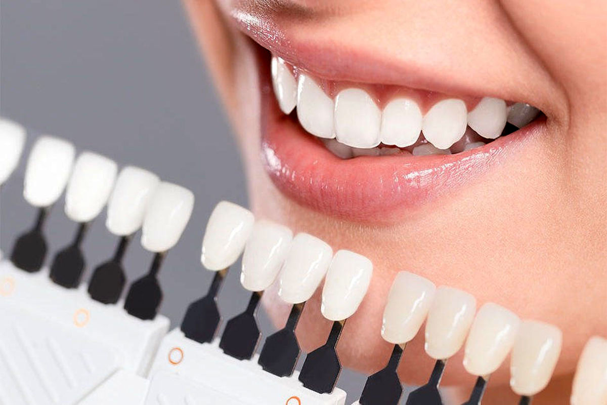 دانستنی هایی در مورد کامپوزیت دندان/ تفاوت کامپوزیت دندان با لمینت چیست؟