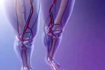 آمبولی شریانی در پاها شایع تر است/ تحرک مهم ترین گام پیشگیری