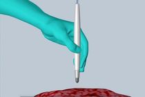 تشخیص بافت سرطانی در چند ثانیه با یک دستگاه قلمی شکل