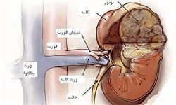 انجام 38 عمل پیوند در هفته اول فروردین ماه/ انجام بیشترین پیوند کلیه در تهران