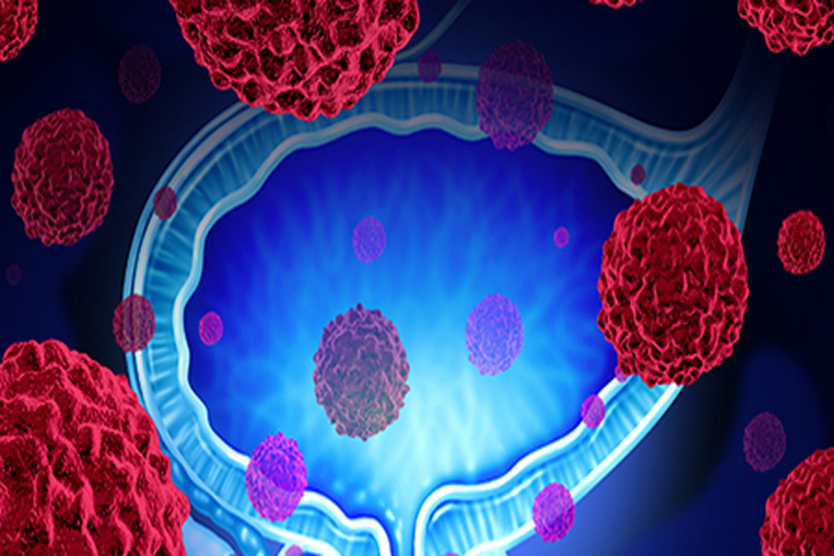 نقش مؤثر ویتامین D در پیشگیری از سرطان مثانه