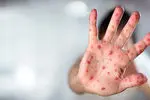 استمرار پایش و اقدامات پیشگیرانه علیه سُرخک در فارس