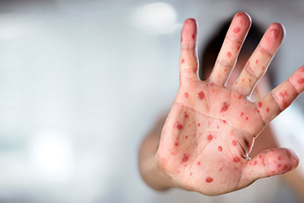 افت نرخ واکسیناسیون دلیل اصلی بازگشت سرخک در کانادا