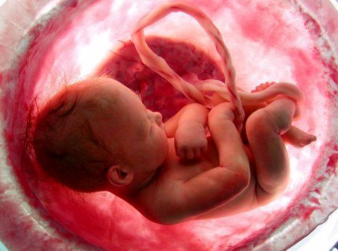 کدام بیماری جنین از طریق سونوگرافی مشخص می‌شود؟
