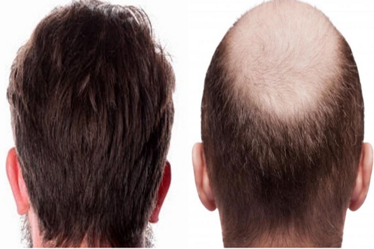 عوارض کاشت مو جلوی سر چیست؟