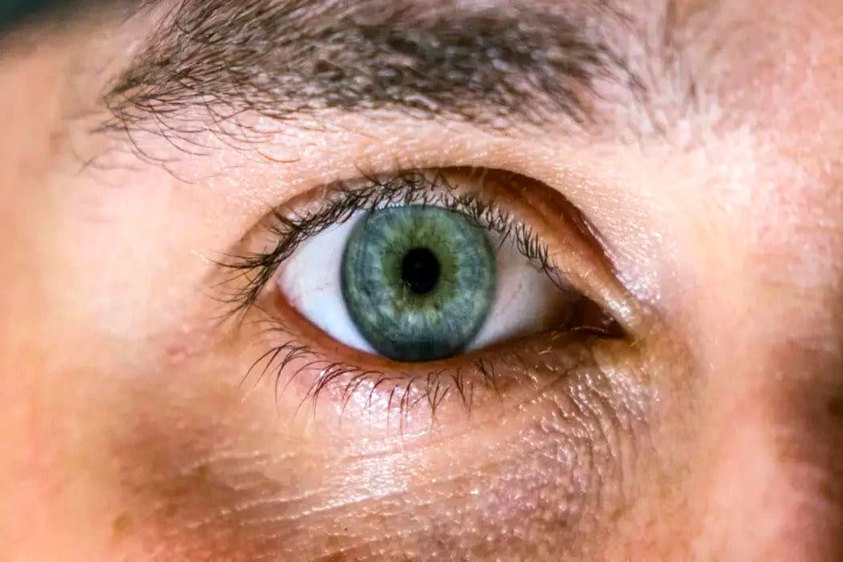علت گودی و سیاهی زیر چشم چیست؟