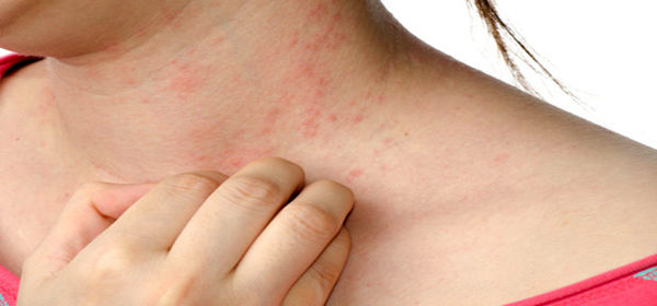 افزایش بیماری‌های پوستی در روزهای آخر سال/ شوینده‌ها از مهمترین علل اگزما