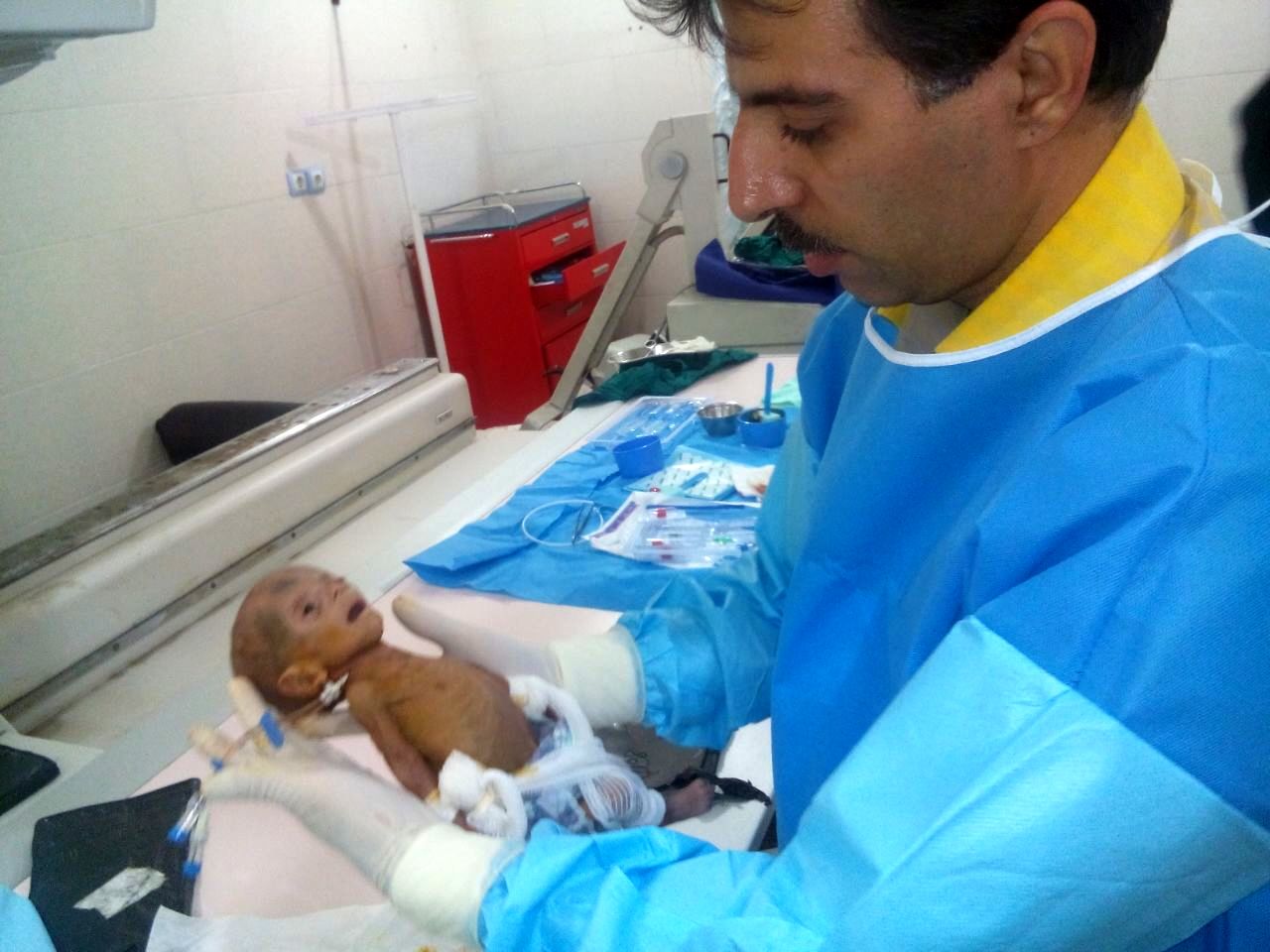 یک نوزاد نارس در بیمارستان گلستان اهواز به روش رادیولوژی مداخله ای کاتترگذاری شد