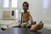 بی تفاوتی جامعه جهانی به فاجعه انسانی در یمن 
