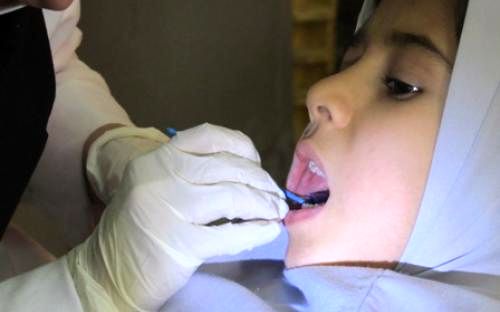 وارنیش فلوراید در دانش‌آموزان ۵۰ درصد پوسیدگی دندان‌ها را کاهش می‌دهد