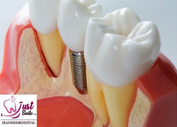 ایمپلنت دندان، بهترین روش جایگزینی دندان های جلو