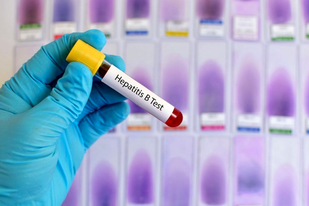 شناسایی بیش از ۷۰ بیمار مبتلا به هپاتیت بی‌ و سی در کاشان و آران‌وبیدگل 
