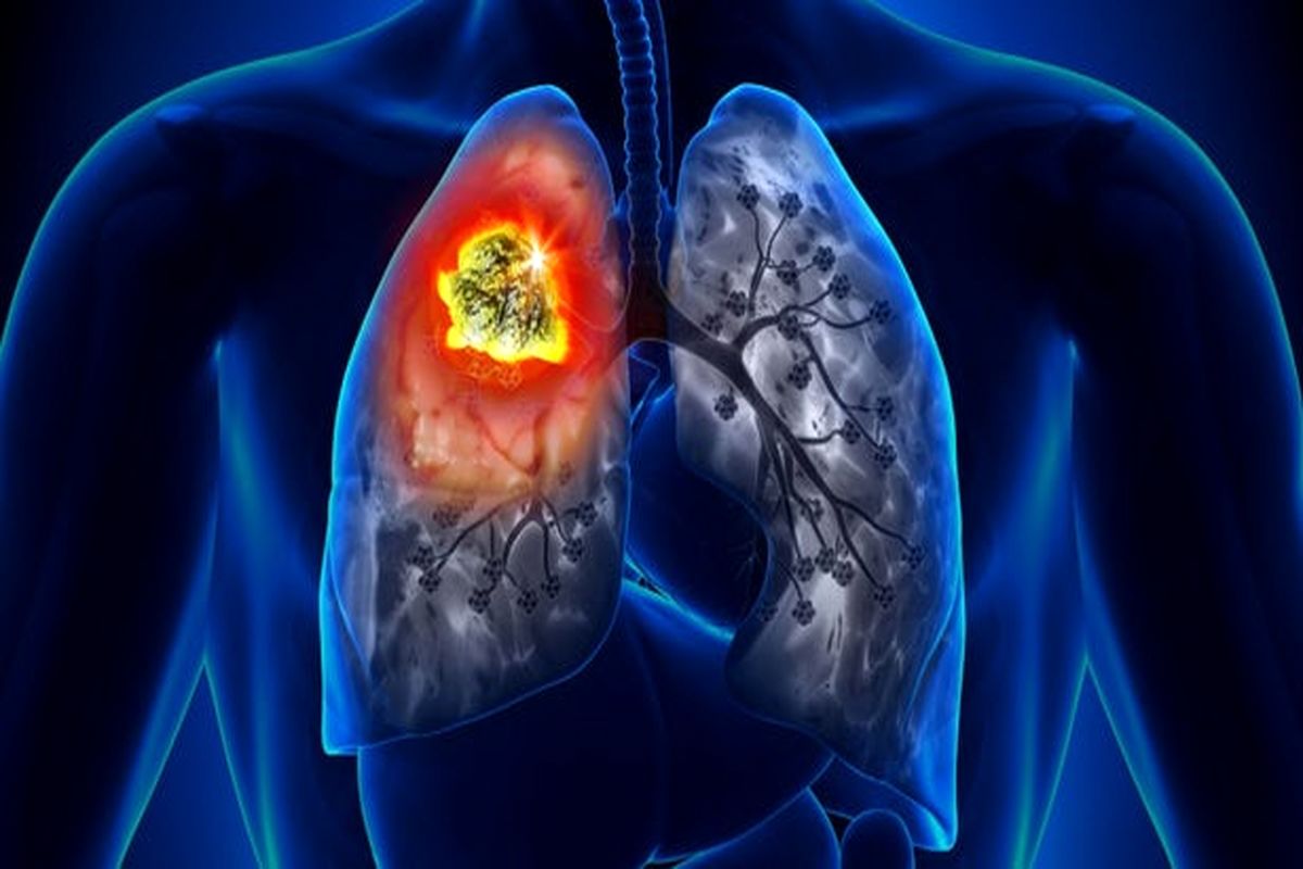 منشا سرطان ریه در غیرسیگاری‌ها 