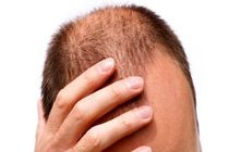 دلایل ریزش مو چیست؟/ پیشگیری از ریزش مو با مصرف کافئین
