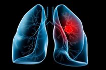 آلودگی هوا عامل ابتلای افراد به سرطان ریه