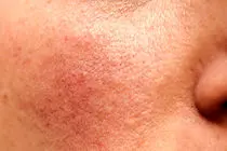 وزارت بهداشت به ورود پزشکان عمومی به حوزه پوست واکنش نشان داد