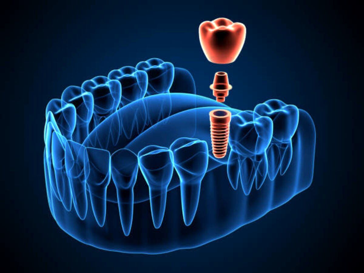 چه مدت بعد از کشیدن دندان می‌توان ایمپلنت انجام داد؟
