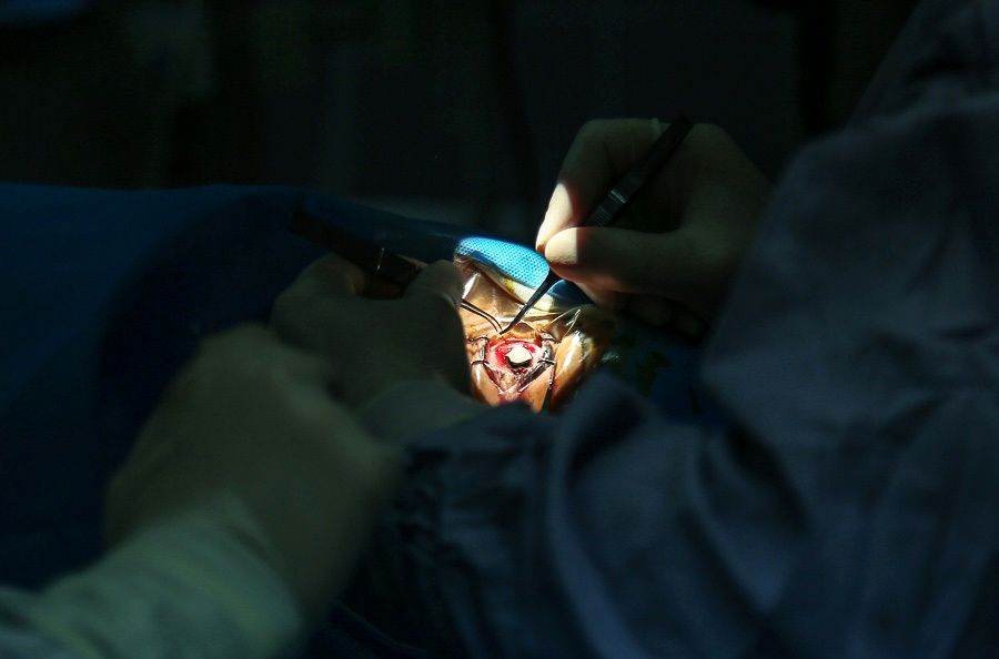 نخستین عمل جراحی پیوند قرنیه چشم در لرستان با موفقیت انجام شد