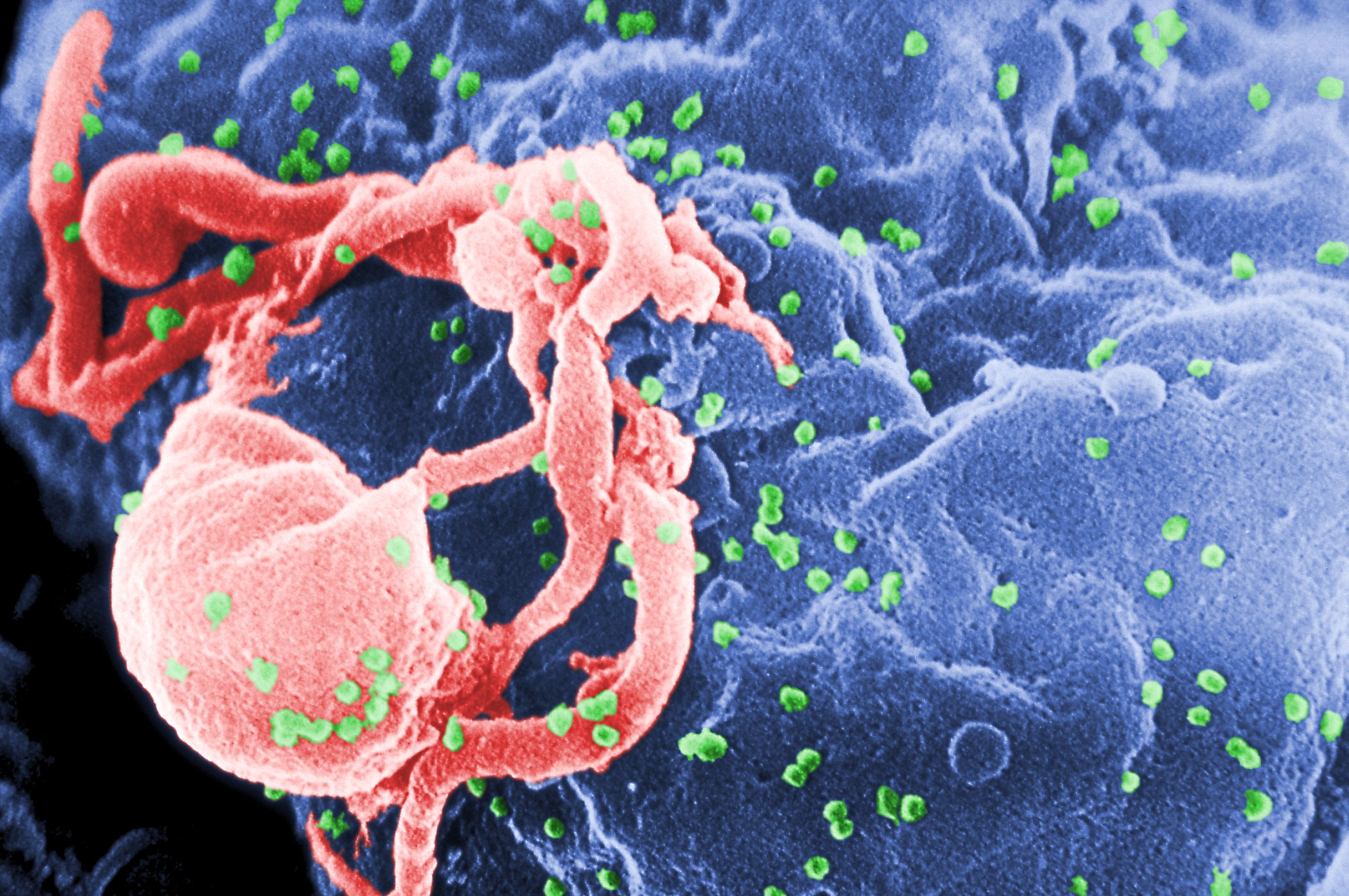 روش مقابله با ویروس اچ آی وی کشف شد