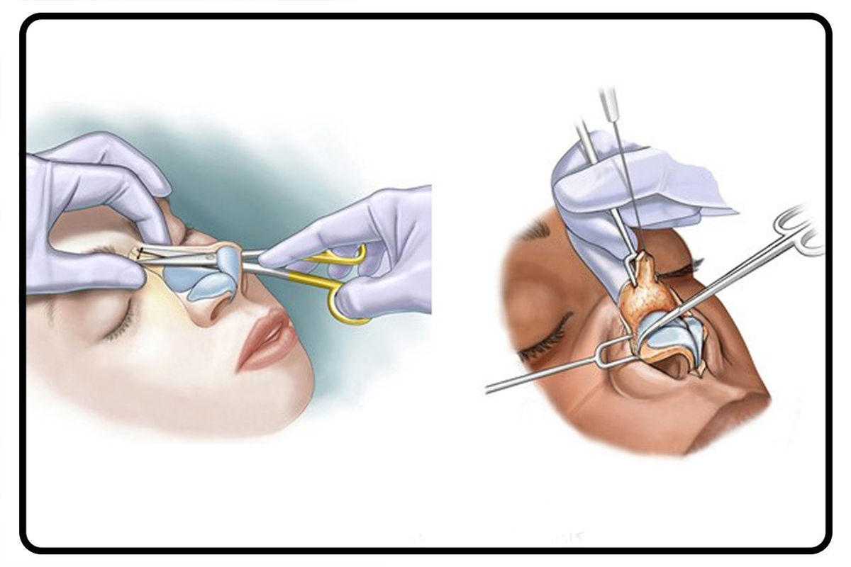 عمل بینی، معایب و مزایا!/ارتباط جراحی بینی و بارداری