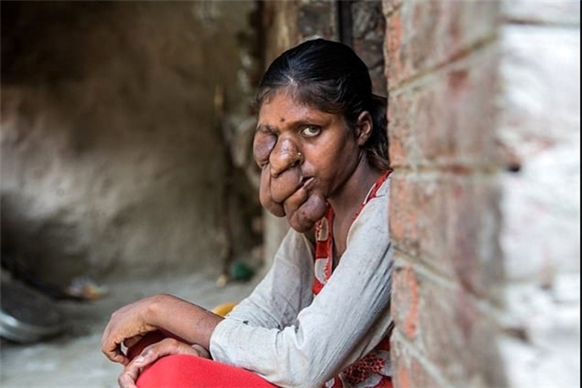 بیماری ژنتیکی عجیب دختر هندی