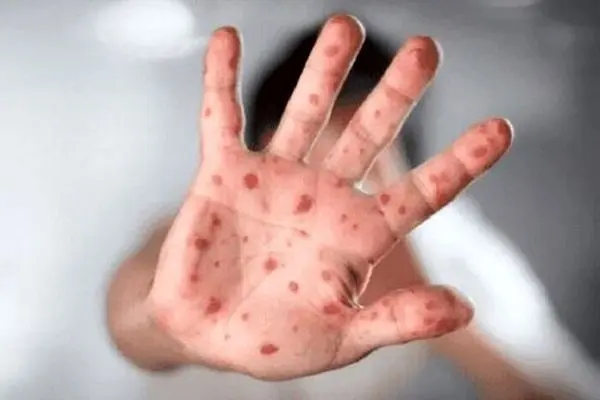 شیوع انسانی آبله میمونی نگران کننده است